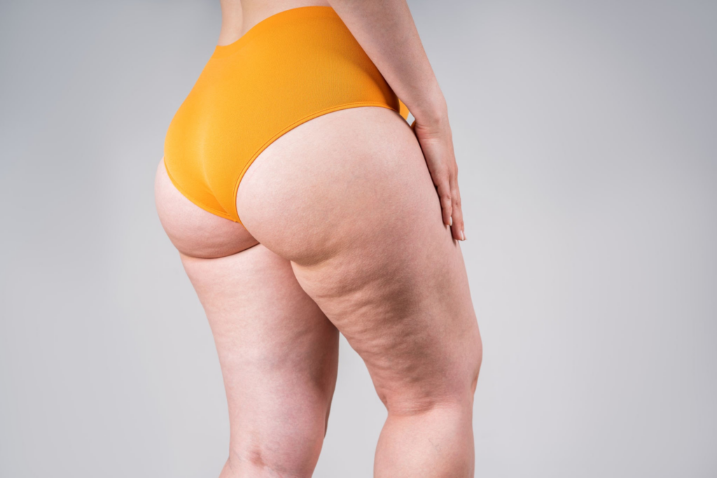 How Does MTF Hip Widening Surgery Differ From Other Gender-Affirming Surgeries? 3