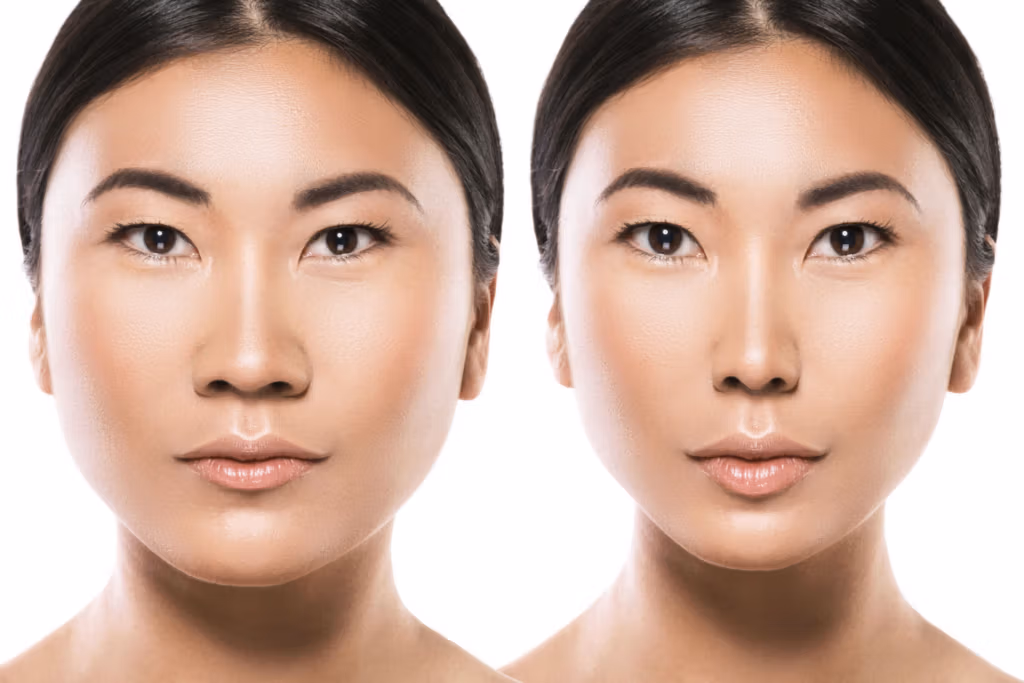 Ein Vorher-Nachher-Vergleichsbild zeigt die Auswirkungen einer Gesichtsverschönerung bei einer asiatischen Frau. Links ist das ursprüngliche Gesicht mit einem natürlicheren Aussehen zu sehen, rechts das Gesicht nach der Operation mit deutlichen Veränderungen der Gesichtszüge, wie einem höheren Nasenrücken und ausgeprägteren Wangenknochen.