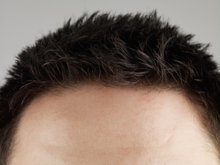 Vista de cerca de la frente de un hombre con una línea de cabello en retroceso, que muestra un cabello ralo y un cuero cabelludo limpio.