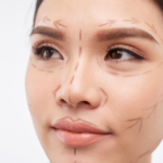 Gros plan sur le visage d'une femme avec des marques préopératoires pour une chirurgie esthétique sur son front, ses yeux et ses joues.