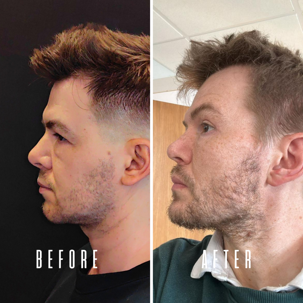 Comparación del rostro de un hombre, con vistas antes y después. La imagen del antes muestra a un hombre con el rostro bien afeitado y cabello corto. La imagen del después muestra al mismo hombre con barba y cabello largo.