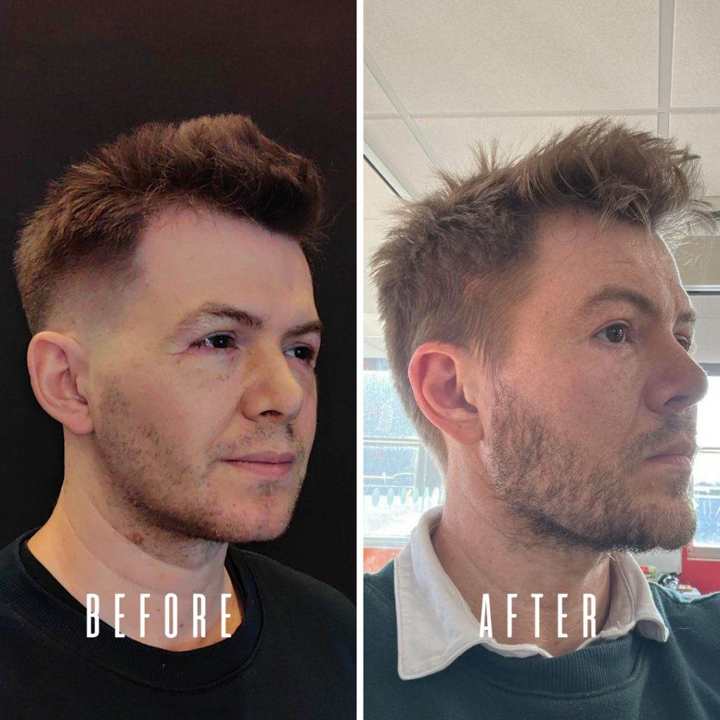 Comparación antes y después de la apariencia facial de un hombre, que muestra mejoras notables en la textura de la piel y una reducción de las cicatrices del acné después del tratamiento.