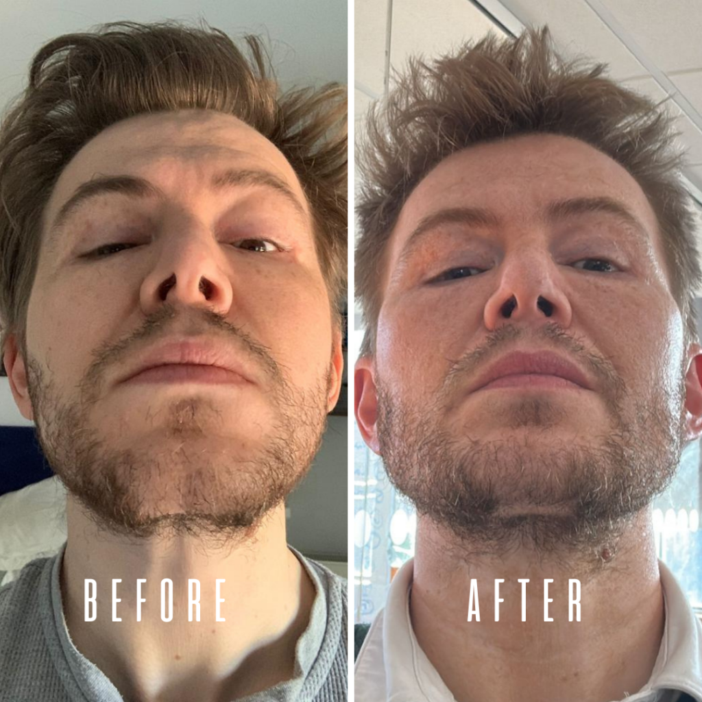 Imagen comparativa del antes y el después que muestra los cambios faciales tras un procedimiento o tratamiento. La imagen izquierda, "ANTES", muestra el rostro de una persona con problemas cutáneos evidentes. La imagen derecha, "DESPUÉS", muestra el rostro de la misma persona con una mejor textura y apariencia de la piel.