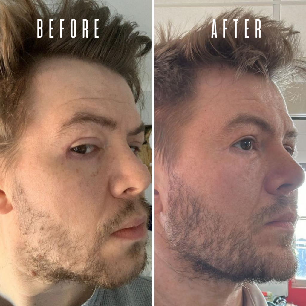 Comparación de antes y después de la apariencia facial de un hombre que muestra mejoras sutiles en la textura y el tono de la piel.