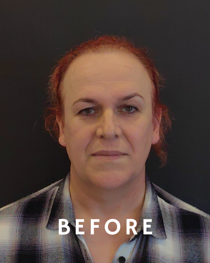 Frontales Porträt einer Frau mit kurzen roten Haaren und kariertem Hemd, aufgenommen vor einem Eingriff. Der Hintergrund ist dunkel, und das Wort „VORHER“ ist in weißer Schrift deutlich am unteren Bildrand zu sehen.