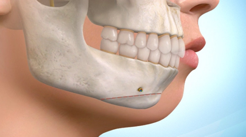 Maxillofaciale osteotomie: het hervormen van de harmonie en functie van het gezicht