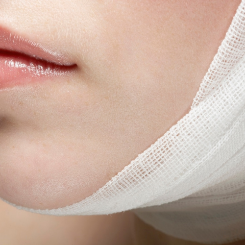 A close-up image of a person's lower face with gauze wrapped around the chin and jaw area, likely indicating post-surgical care or a medical procedure involving the jaw or chin.