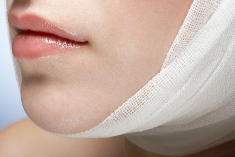 Una imagen de primer plano de la parte inferior del rostro de una persona con una gasa envuelta alrededor del mentón y la zona de la mandíbula, lo que probablemente indica atención posquirúrgica o un procedimiento médico que involucra la mandíbula o el mentón.