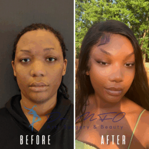 Фотографии пациента до и после, демонстрирующие результаты косметической процедуры: слева — изображение «до», справа — изображение «после». На обоих изображениях имеется логотип «Dr. MFO Aesthetic Surgery and Beauty».