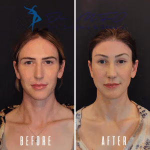 Before and after images of a female patient who underwent facial feminization surgery, showcasing changes in facial structure, particularly in the jawline, cheeks, and forehead. The images highlight the transformation achieved through surgical procedures.