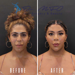 Фотографии женщины до и после косметической процедуры в клинике Dr. MFO Art Surgery & Beauty. На фото «до» она с естественными вьющимися волосами и расслабленным выражением лица. На фото «после» она с уложенными волосами и более чётким выражением лица, что подчёркивает результат процедуры.