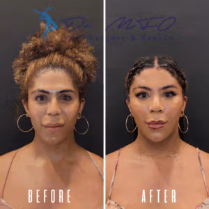 Before and after photos of a woman who underwent a cosmetic procedure at Dr. MFO Art Surgery & Beauty. The 'before' image shows her with natural curly hair and a relaxed facial expression. The 'after' image displays her with styled hair and a more defined facial appearance, highlighting the results of the procedure.