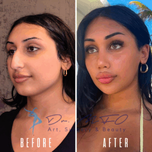 Сравнение женского лица до и после, демонстрирующее результаты косметических процедур. На изображении «до» слева показан естественный вид с минимальным макияжем, а на изображении «после» справа видны улучшенные черты лица, включая более пухлые губы, чётко очерченные брови и более скульптурную форму лица. Оба изображения отмечены логотипом «Dr. MFO Art, Surgery & Beauty».