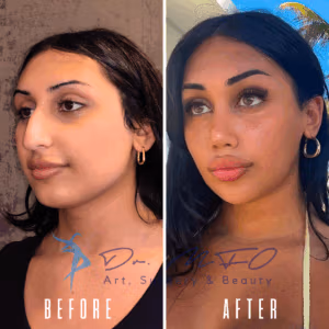 Before and after comparison of a woman's face, showcasing the results of cosmetic procedures. The 'before' image on the left displays a natural appearance with minimal makeup, while the 'after' image on the right reveals enhanced features, including fuller lips, defined eyebrows, and a more sculpted facial structure. Both images are marked with the logo of 'Dr. MFO Art, Surgery & Beauty.'