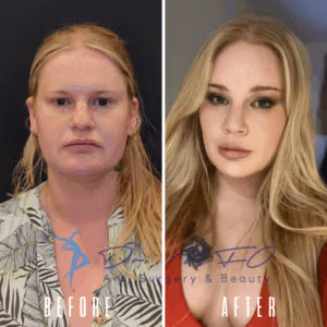 Before and after photos of a woman who underwent cosmetic surgery, showing significant changes in facial features and overall appearance.
