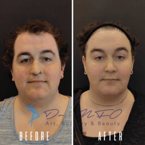 Фотографии пациентки, перенесшей операцию по феминизации лица, до и после, демонстрирующие изменения черт лица, линии роста волос и общего внешнего вида.