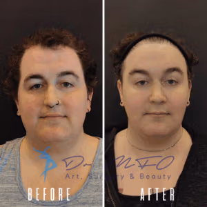 Before and after photos of a patient who underwent facial feminization surgery, showcasing changes in facial features, hairline, and overall appearance.