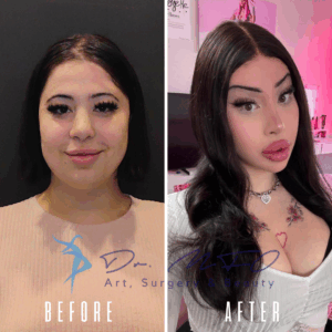 Сравнение лица женщины до и после, демонстрирующее результаты косметических процедур. На изображении «до» она выглядит естественно, а на изображении «после» видны её улучшенные черты лица, включая более пухлые губы, чётко очерченные брови и уложенные волосы. На обоих изображениях виден логотип «Dr. MFO Art, Surgery & Beauty».