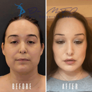 Фотографии человека, прошедшего косметическую процедуру, до и после, демонстрирующие заметные изменения черт лица, вероятно, включающие улучшение бровей, губ и общего контура лица.