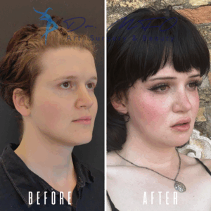 Сравнение черт лица человека до и после, демонстрирующее изменения в прическе, макияже и общем внешнем виде. Изображение, вероятно, демонстрирует результаты косметической или хирургической процедуры, акцентируя внимание на преображении внешнего вида человека.