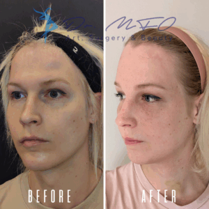 Сравнение лиц до и после, демонстрирующее результаты косметической процедуры. На изображении «до» слева виден неровный тон кожи и заметные недостатки, а на изображении «после» справа — улучшенная текстура кожи и уменьшение дефектов.