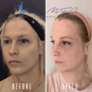 Before and after comparison of a person's face, showing the results of a cosmetic procedure. The 'before' image on the left shows uneven skin tone and visible blemishes, while the 'after' image on the right displays improved skin texture and reduced blemishes.