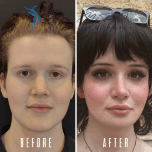 Сравнение изменений лица человека до и после: на изображении «до» лицо более полное со светлыми волосами, а на изображении «после» — более четкая структура лица с темными волосами и макияжем.