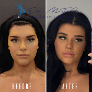 Фотографии пациентки, перенесшей ринопластику, до и после, демонстрирующие изменения формы носа и общего внешнего вида лица.