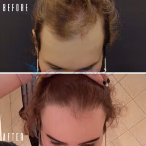 Before and after comparison showing hair regrowth on a person's scalp, highlighting the improvement in hair density and coverage.