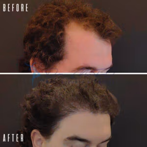 Before-and-after comparison of hair transplant results, showing a person with thinning hair before the procedure and the same person with thicker, fuller hair after the procedure.