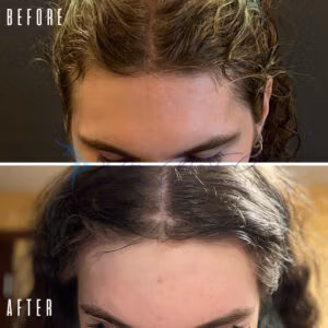 A before-and-after comparison of hair growth treatment. The 'before' image shows a person with thinning hair, while the 'after' image shows the same person with thicker, fuller hair after treatment.
