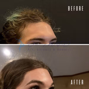 Before and after comparison of a hair transplant procedure, showing the front hairline with noticeable improvement in hair density and coverage. The images highlight the results of surgical hair restoration.