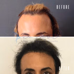 Before and after comparison of a person's hairline restoration. The 'before' image shows a receded hairline with thinning hair, while the 'after' image displays a fuller, more even hairline after treatment.