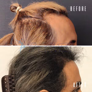A before-and-after comparison photo of a hair transplant procedure shows the top of a person's head with thinning hair in the "before" section and the same area with significantly improved hair density in the "after" section.