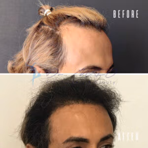Before and after comparison of hair restoration treatment, showing significant improvement in hair density and coverage. The 'before' image displays thinning hair and visible scalp, while the 'after' image shows a fuller, thicker head of hair.