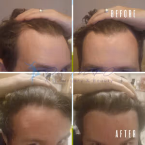 Before and after comparison of a hairline lowering procedure, showing a higher forehead with a receded hairline in the before images and a lowered hairline with increased hair coverage in the after images.