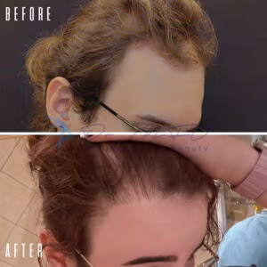 Before and after photos of a hair transplant procedure showing the side of a patient's head. The 'before' image displays noticeable hair loss, while the 'after' image shows significant hair regrowth and increased density.