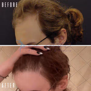 A before-and-after comparison image showing hair restoration results. The 'BEFORE' image at the top displays a person with noticeable hair loss, revealing a significant portion of the scalp. The 'AFTER' image below shows the same person with a fuller head of hair, indicating successful hair restoration treatment.
