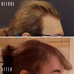 Before and after photos of hair restoration treatment showing significant hair growth and improvement in hair density.