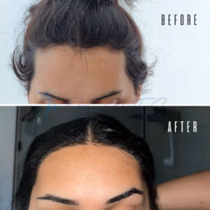Before and after images of a hair transplant procedure. The top image shows a person with noticeable hair thinning and balding areas on the scalp. The bottom image shows the same person after the hair transplant, with a fuller and more evenly distributed hairline.