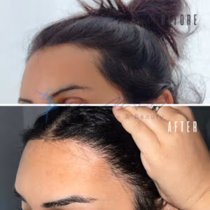 Before and after comparison of a hairline lowering procedure showing the hairline before the surgery and the improved hairline after the procedure.