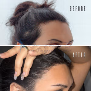A before-and-after comparison showing hair restoration results. The top image labeled 'BEFORE' shows a person with noticeable hair thinning or loss at the hairline. The bottom image labeled 'AFTER' shows the same person with a fuller, restored hairline, demonstrating the effectiveness of the hair restoration treatment.