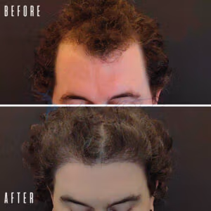Before and after comparison of hair restoration treatment. The top image labeled 'BEFORE' shows a person with thinning hair and visible scalp. The bottom image labeled 'AFTER' shows the same person with significantly increased hair density and fuller coverage.