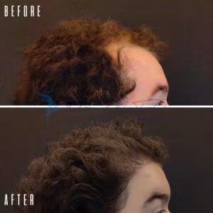 Before and after images of a woman showcasing the results of a hair restoration procedure, highlighting the improvement in hair density and coverage.