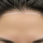 Photo of a person's forehead with a marked line indicating hairline measurement or treatment area.
