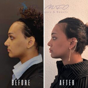 Ein Vorher-Nachher-Vergleich zeigt das Seitenprofil eines Gesichts. Das Vorher-Bild befindet sich links, das Nachher-Bild rechts. Beide Bilder zeigen dieselbe Person, das Nachher-Bild zeigt jedoch deutliche Veränderungen der Gesichtszüge, insbesondere im Nasen- und Wangenbereich, was auf einen möglichen kosmetischen Eingriff hindeutet.