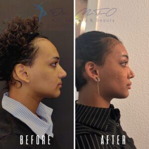 Ein Vorher-Nachher-Vergleich zeigt das Seitenprofil des Gesichts einer Person. Das Vorher-Bild zeigt die Person mit einem auffälligen Höcker auf der Nase, während das Nachher-Bild dieselbe Person mit einer begradigten Nase nach einem chirurgischen Eingriff zeigt.