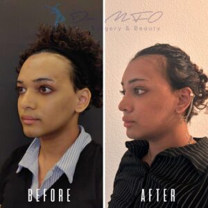 Ein Vorher-Nachher-Vergleich des Gesichts einer Person, der Veränderungen zeigt, die wahrscheinlich auf einen medizinischen oder kosmetischen Eingriff zurückzuführen sind. Das Vorher-Bild zeigt die Person mit deutlicher Akne und ungleichmäßiger Hautstruktur, während das Nachher-Bild reinere Haut und eine glattere Struktur zeigt.