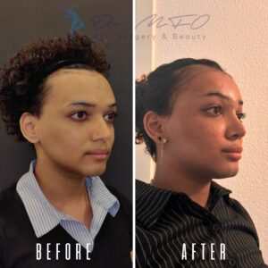 Vorher-Nachher-Fotovergleich, der die Ergebnisse eines kosmetischen Eingriffs zeigt. Das Vorher-Bild zeigt eine Person mit auffälligen Gesichtszügen, die sich von denen des Nachher-Bildes unterscheiden, da diese Merkmale verstärkt oder verändert wurden. Das Vorher-Bild trägt unten links den Text „VORHER“, das Nachher-Bild unten rechts den Text „NACHHER“. Die Person auf beiden Bildern trägt ein dunkles Hemd mit hellem Kragen.