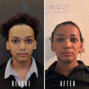 Ein Vorher-Nachher-Vergleich zeigt die Ergebnisse eines kosmetischen Eingriffs. Das Vorher-Bild links zeigt eine Person mit auffälligen Gesichtszügen, die sie verändern wollte. Das Nachher-Bild rechts zeigt dieselbe Person nach einem Eingriff, wahrscheinlich einer Nasenkorrektur, mit einer verfeinerten und ästhetisch ansprechenderen Nasenform.